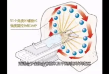 什么是螺旋断层放疗系统-器械之心