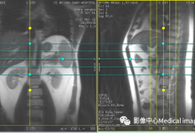GE磁共振肝脏扫描技术-器械之心