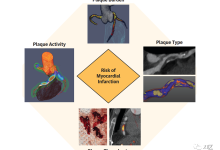 【XI区】无创冠脉粥样硬化斑块成像最新进展（上）-器械之心