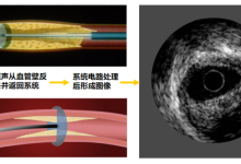 血管内超声（IVUS）的临床应用-器械之心