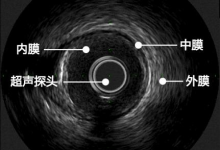 基于内置微型马达的血管内超声(IVUS)导管的设计及研制-器械之心