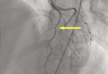 血管内超声(IVUS)深度报告：原理、技术、应用、市场与竞争-器械之心