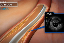血管内超声动画演示-器械之心