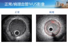 零基础IVUS使用教程——浙江大学邵逸夫医院黄翯主任-器械之心