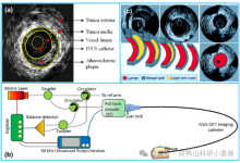 一文解读血管内超声（IVUS）的技术原理、临床应用-器械之心