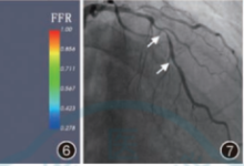 FFR基本概念、标准操作及正确读图-器械之心
