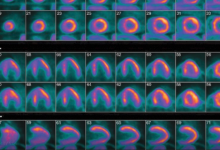 心脏成像的三大重大突破：PET、心脏MR、心脏 CT-器械之心