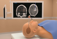 【3D医学动画】术中导航技术在脑出血治疗中的应用-器械之心