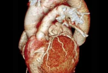 新专家共识将心脏 CT成像作为可量化标准-器械之心