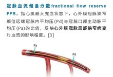 MBF CFR FFR 傻傻分不清楚？-器械之心